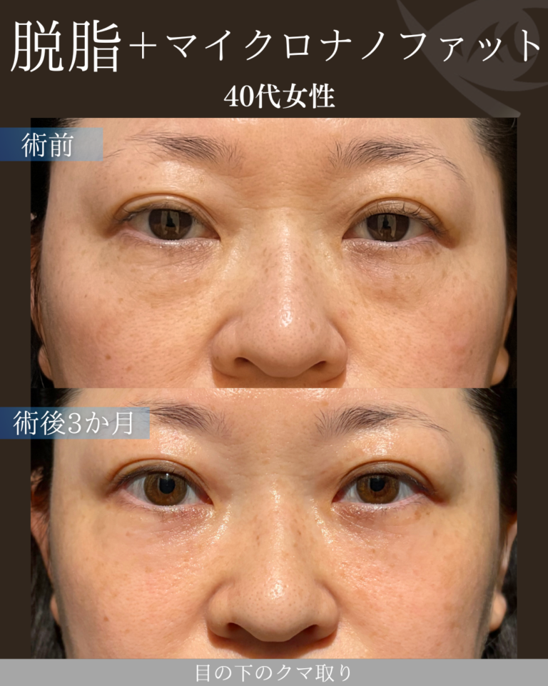 40代女性 脱脂＋マイクロナノファット 術後3ヶ月